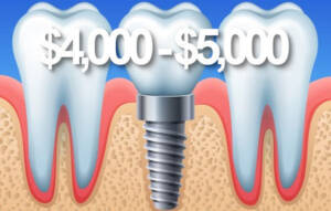 Price Dental Implants Perth WA and Brisbane QLD